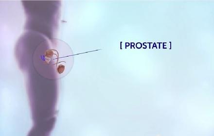 Parama gydant prostatos vėžį nuotraukėlė
